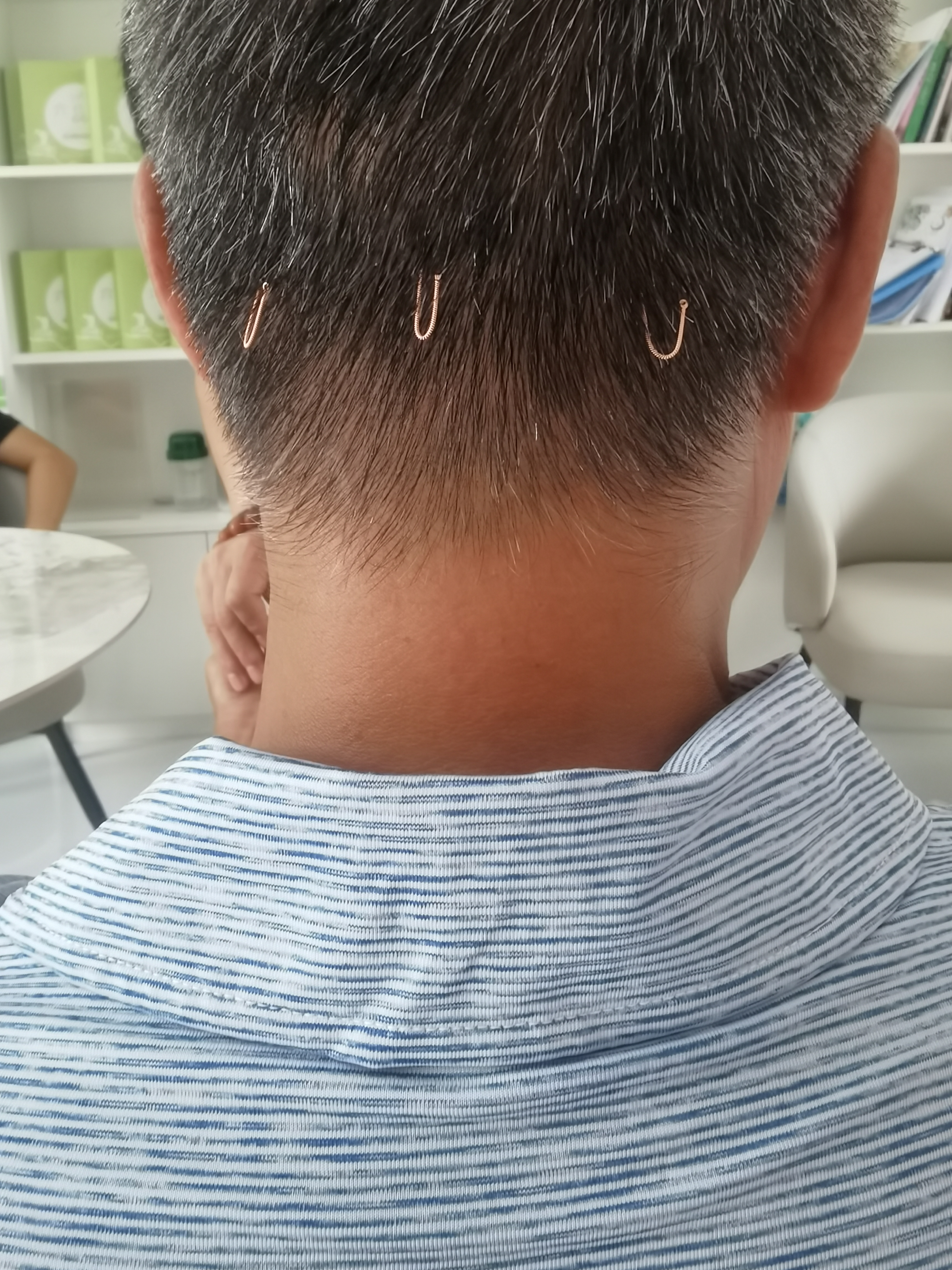 颈部三针改善颈椎紧绷疼痛-吾爱推拿